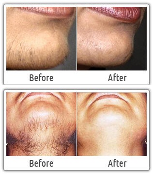 chin lip hair removal