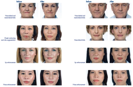 how dermal fillers work