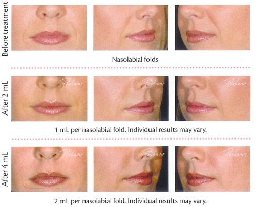 lip gel fillers