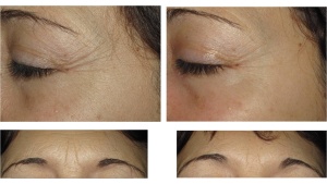 corrective before and aftre